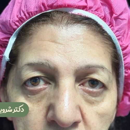 قبل از بلفاروپلاستی + دایرکت ابرو