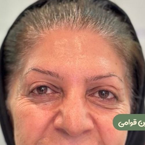 بعد از بلفاروپلاستی + دایرکت ابرو