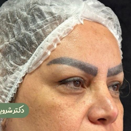 قبل از بلفاروپلاستی + دایرکت ابرو + لیفت شقیقه
