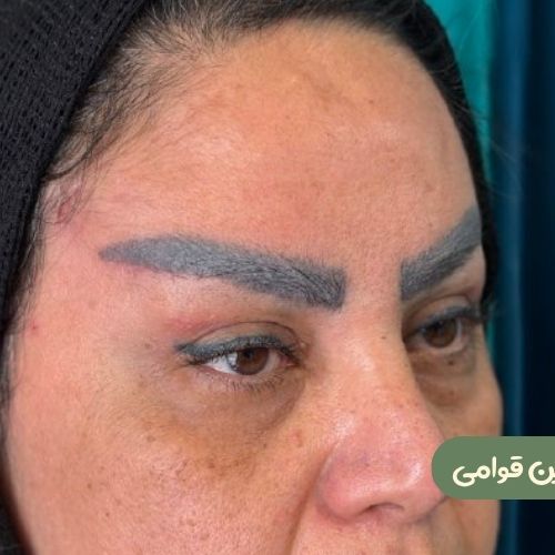 بعد از بلفاروپلاستی + دایرکت ابرو + لیفت شقیقه