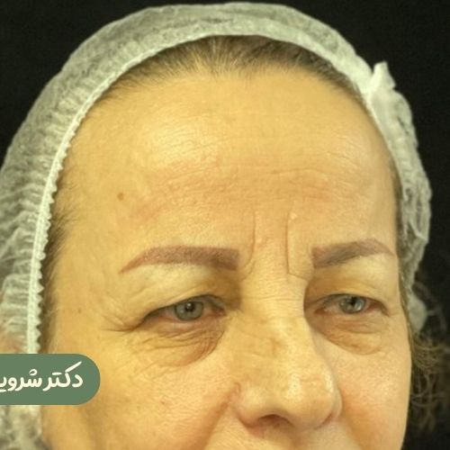 قبل از بلفاروپلاستی +  دایرکت ابرو