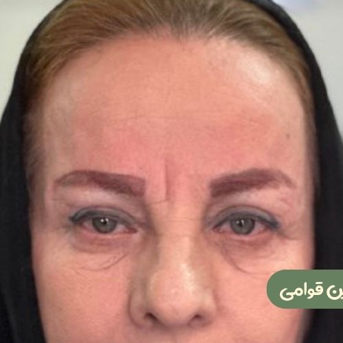 بعد از بلفاروپلاستی +  دایرکت ابرو