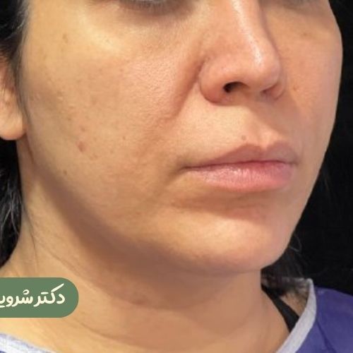 قبل از بوکال فت + سانترال لب