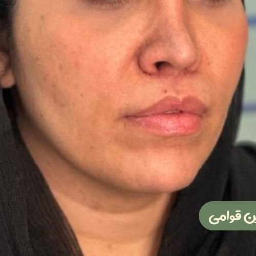 بعد از بوکال فت + سانترال لب