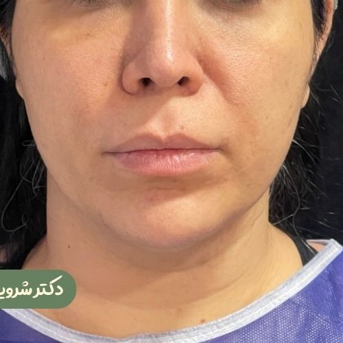 قبل از بوکال فت + سانترال لب