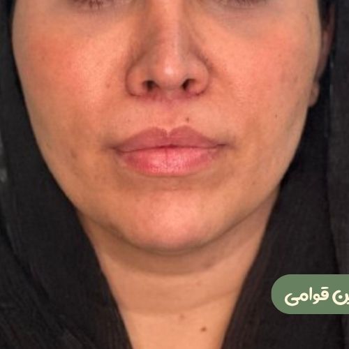 بعد از بوکال فت + سانترال لب