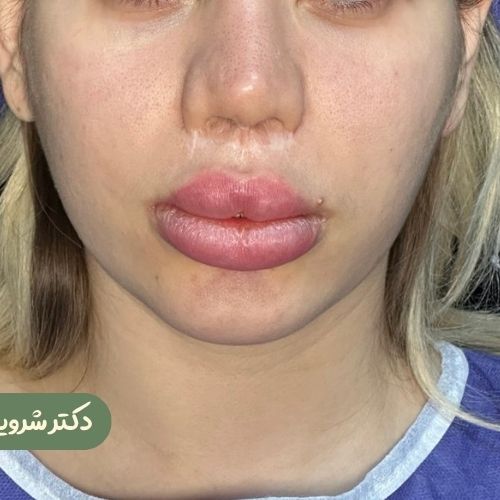 قبل از بوکال فت 