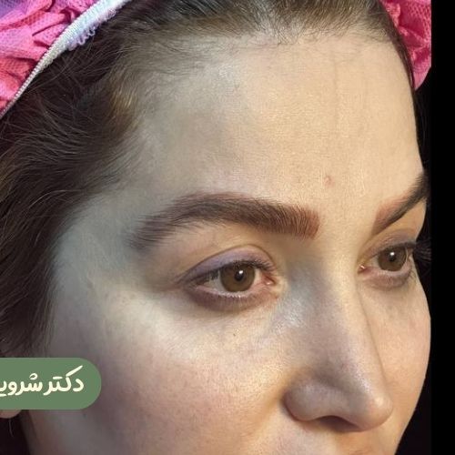قبل از لیفت شقیقه