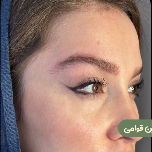 بعد از لیفت شقیقه