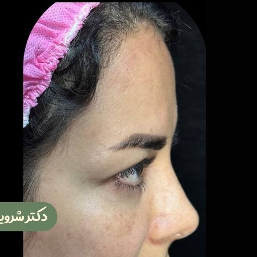 قبل از لیفت شقیقه