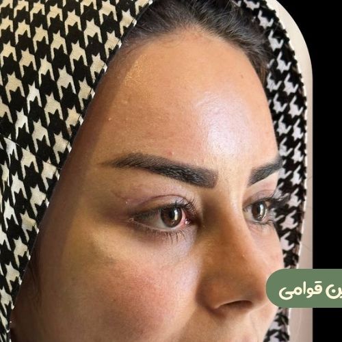 بعد از لیفت شقیقه