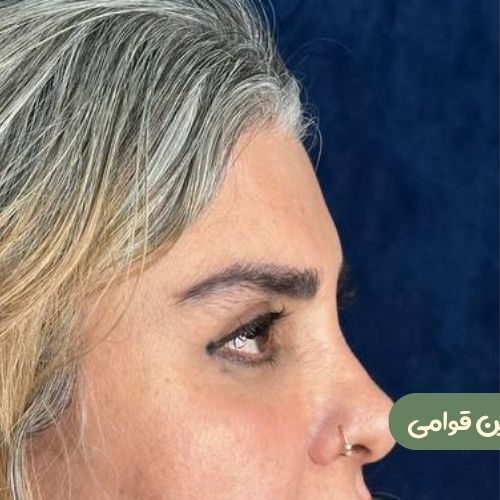 بعد از لیفت شقیقه