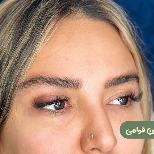 بعد از لیفت شقیقه