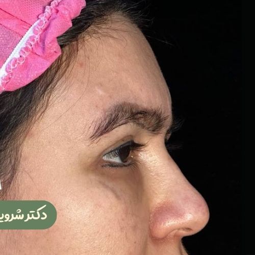 قبل از لیفت شقیقه