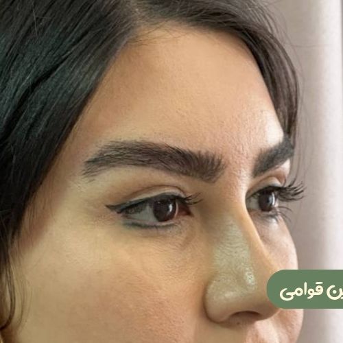 بعد از لیفت شقیقه