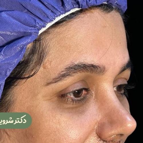 قبل از لیفت شقیقه