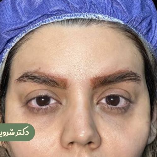 قبل از لیفت شقیقه