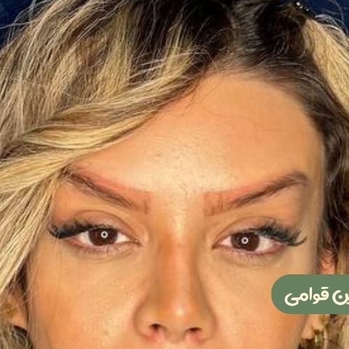 بعد از لیفت شقیقه