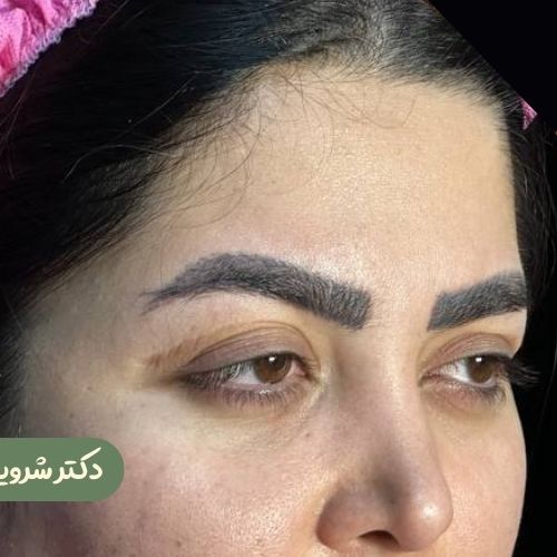 قبل از لیفت شقیقه