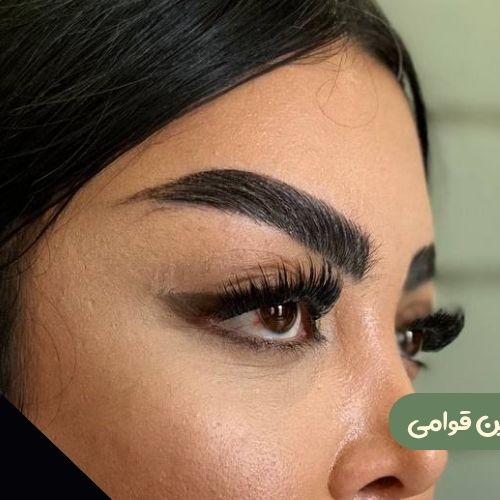 بعد از لیفت شقیقه