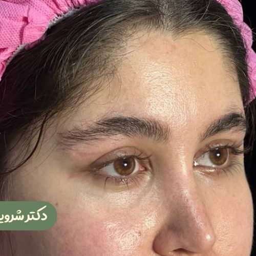 قبل از لیفت شقیقه