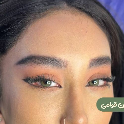 بعد از لیفت شقیقه