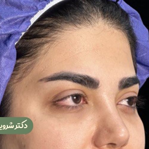 قبل از لیفت شقیقه