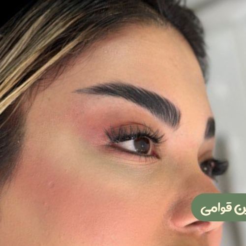 بعد از لیفت شقیقه