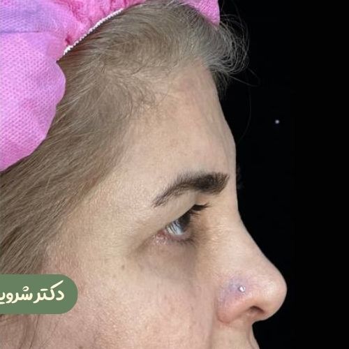 قبل از لیفت شقیقه
