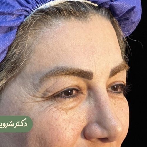 قبل از بلفاروپلاستی + لیفت شقیقه