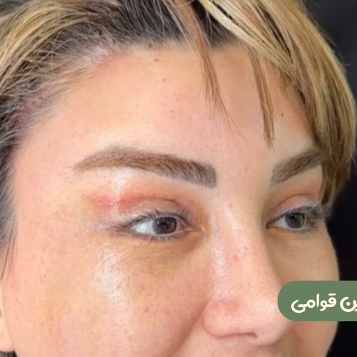 بعد از بلفاروپلاستی + لیفت شقیقه
