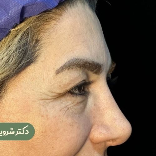 قبل از بلفاروپلاستی + لیفت شقیقه 