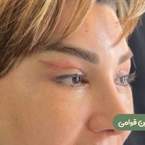بعد از بلفاروپلاستی + لیفت شقیقه 