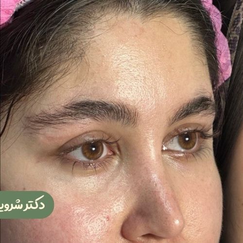 قبل از لیفت شقیقه