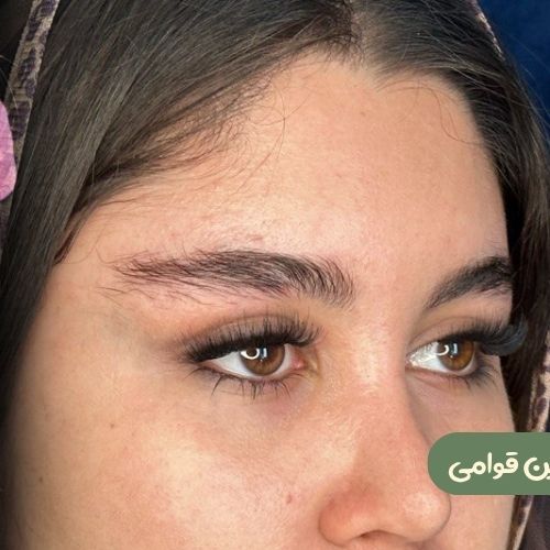 بعد از لیفت شقیقه