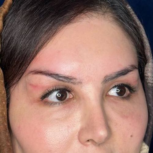 بعد از بلفاروپلاستی