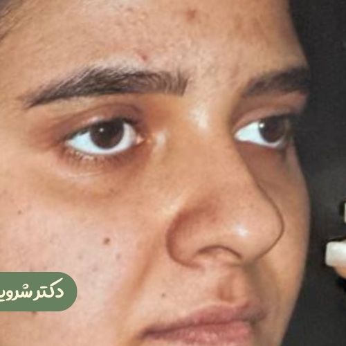 قبل از رینوپلاستی