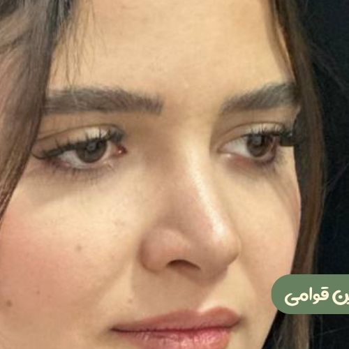 بعد از رینوپلاستی
