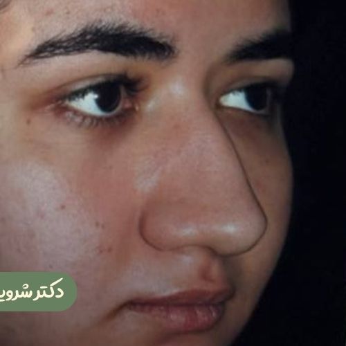 قبل از رینوپلاستی