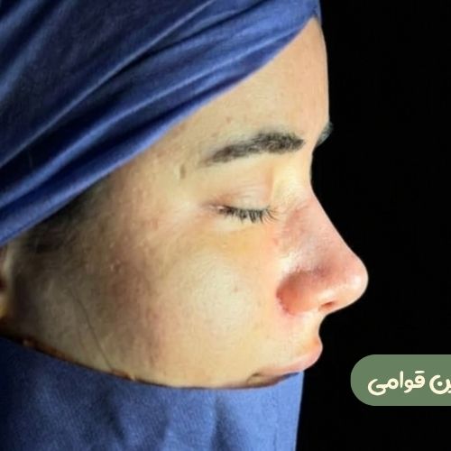 بعد از رینوپلاستی