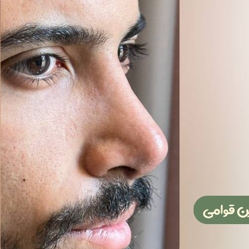 بعد از رینوپلاستی