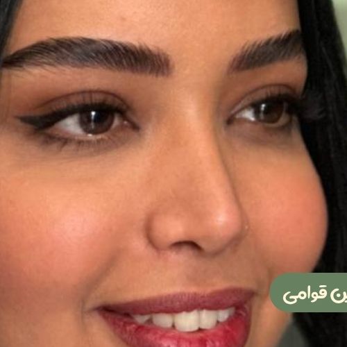 بعد از رینوپلاستی