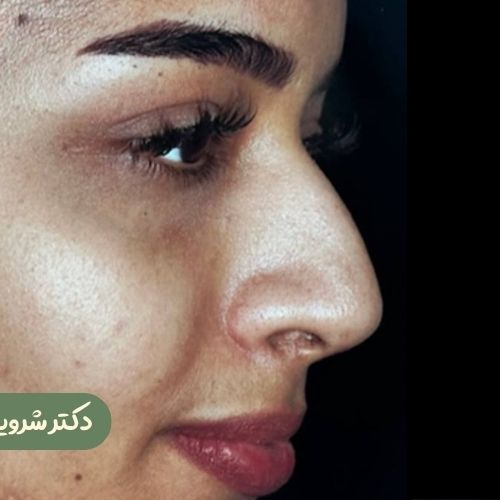 قبل از رینوپلاستی