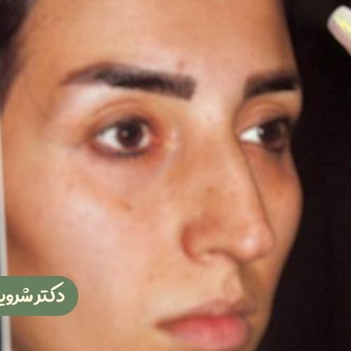 قبل از رینوپلاستی
