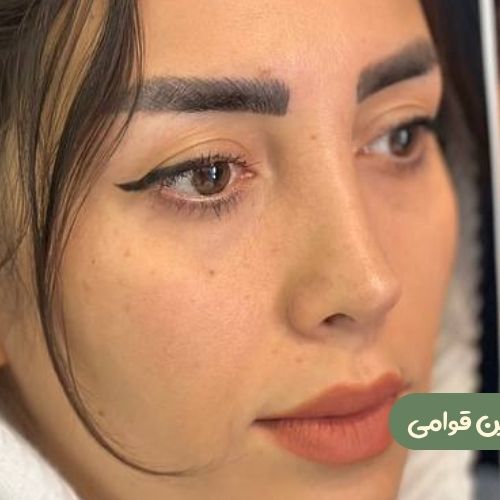 بعد از رینوپلاستی