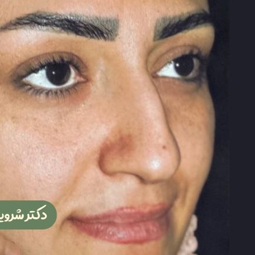 قبل از رینوپلاستی