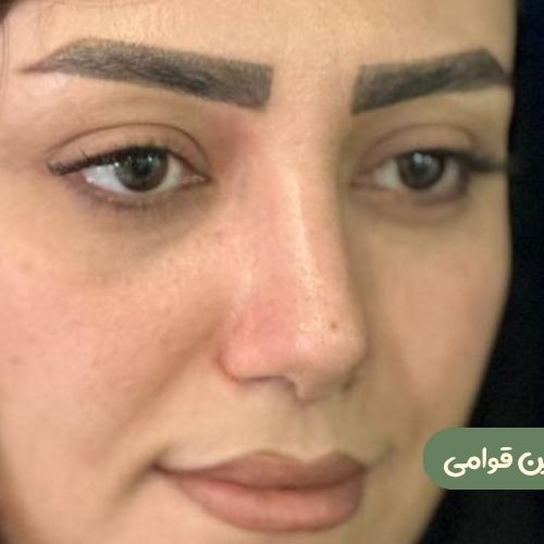 بعد از رینوپلاستی