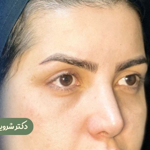 قبل از بلفاروپلاستی