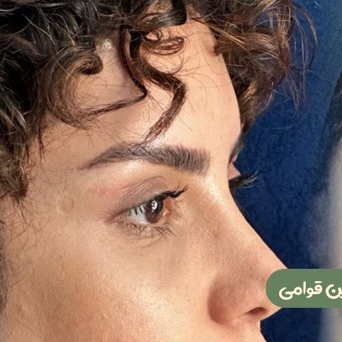 بعد از بلفاروپلاستی