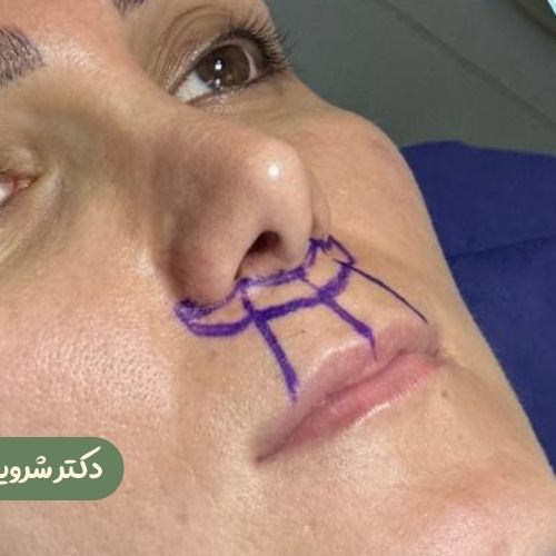 قبل از سانترال لب